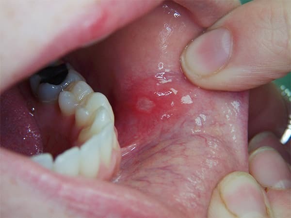 Рак полости рта - симптомы начальной стадии, диагностика, фото