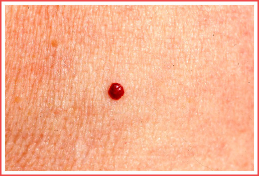 От чего на теле появляются маленькие мелкие красные точки – что это у ребенка, у взрослого, фото