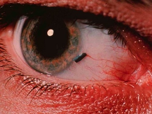 Частое моргание глазами у взрослых: причины, лечение