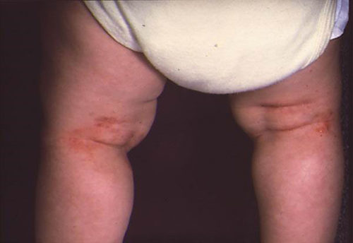 Дерматит: фото на ногах, фото с признаками болезни