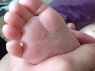 Виды высыпаний на ладонях и руках у ребенка и взрослого: фото и причины