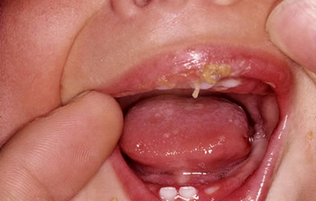 Признаки и фото стоматита у детей во рту