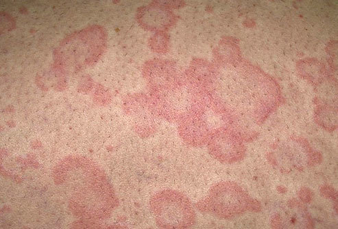 Маленькие красные шелушащиеся сухие пятна на теле: причины появления