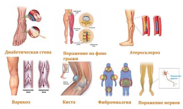 Немеет левая нога: причины и лечение недуга