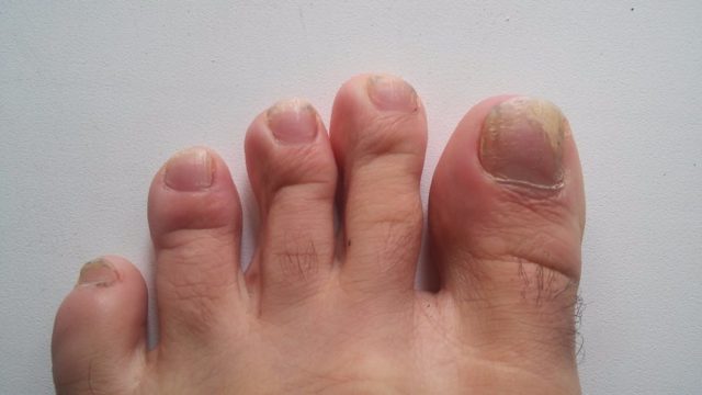 Клотримазол для лечения грибка ногтей на ногах