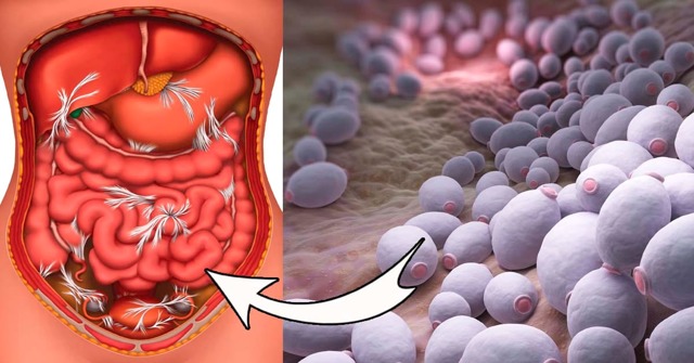 Кандидоз кишечника - причины, симптомы, диагностика и лечение