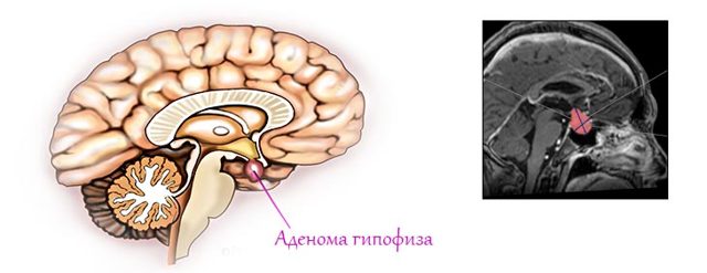 Аденома гипофиза: основные причины появления опухоли головного мозга у женщин и мужчин, симптомы, гормоны, прогноз