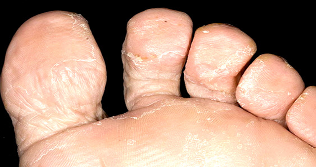 Грибок между пальцами ног - чем лечить?