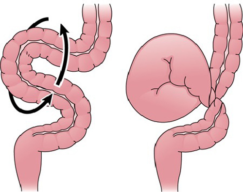 Некроз кишечника – некроз тонкого кишечника, симптомы некроза кишечника, лечение некроза кишечника