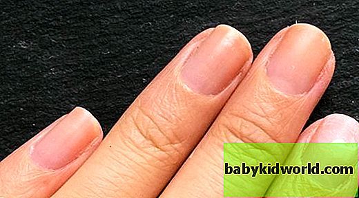 Ребристые ногти на руках: причины у женщин, почему ногтевая пластина стала вертикально и вдоль с полосками, бугристые неровности, лечение