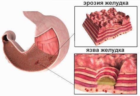 Эрозия желудка - симптомы и лечение заболевания