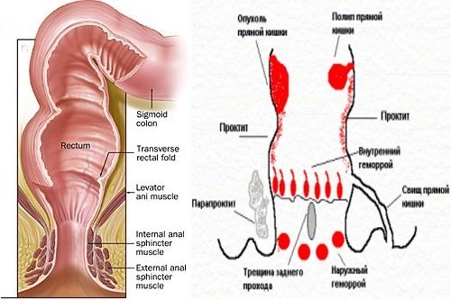 Боль в прямой кишке болезни симптомы диагностика лечение профилактика рекомендации