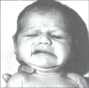 Врожденный паралич лицевого нерва у новорожденных
