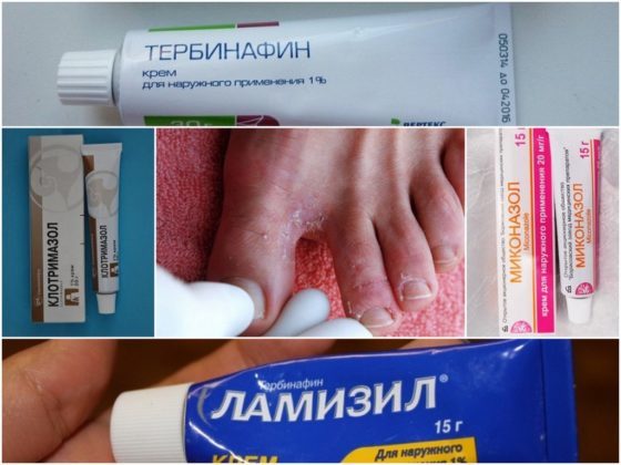 Как лечить грибок между пальцами ног: аптечные мази и кремы