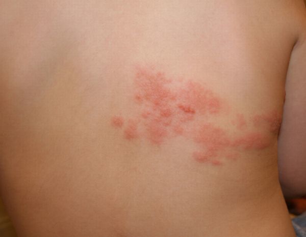 Белые пятна на спине (коричневые, красные): причины и лечение