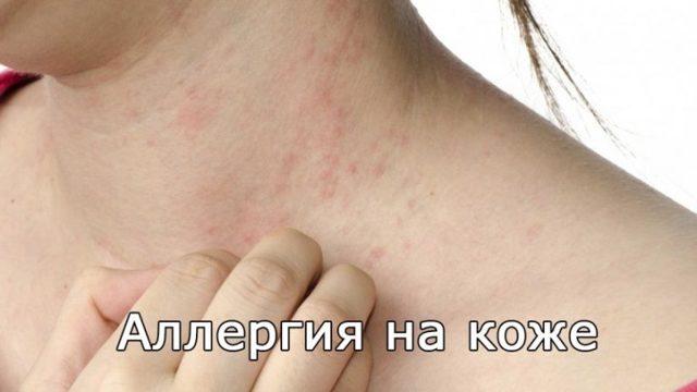 Красные пятна на коже у взрослых и детей - виды высыпаний и их фото, аллергия с зудом и без