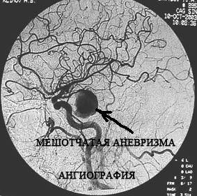 Эндоваскулярная хирургия аневризм артерий головного мозга – этапы проведения