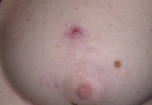 Фурункул на грудине у женщин: причины и лечение