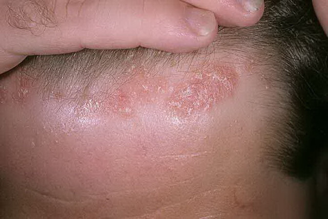 Раздражение кожи головы - лечение и причины.