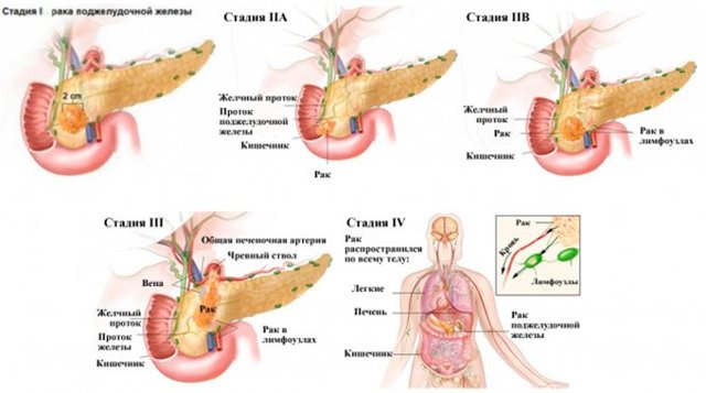 Рак поджелудочной железы: первые симптомы (проявления), фото
