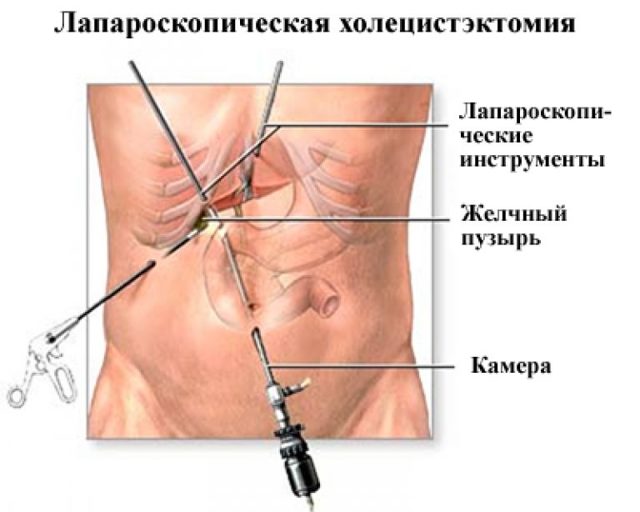 Лапароскопическая холецистэктомия: ход операции, подготовка