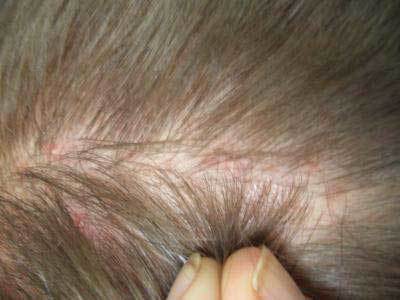 Болячка на голове под волосами: возможные причины появления и методы лечения