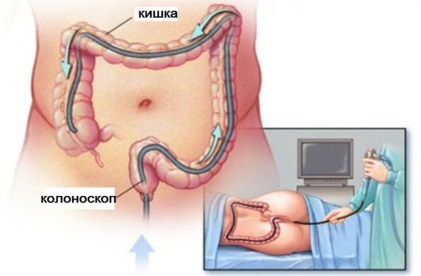 Как проверить кишечник без колоноскопии