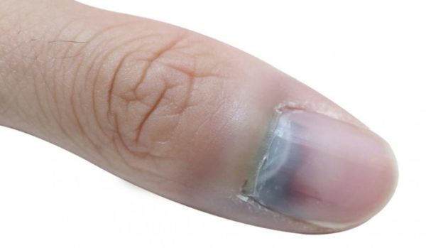 Доброкачественные опухоли ногтя и возле ногтя
