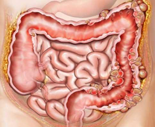 Пневматоз кишечника - что это такое, симптомы и лечение
