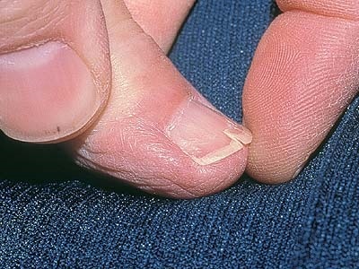 Трещина на ногте — причины и что делать?