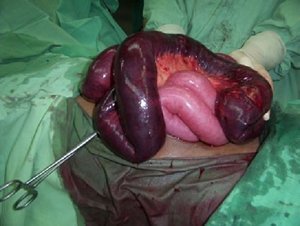 Некроз кишечника – некроз тонкого кишечника, симптомы некроза кишечника, лечение некроза кишечника
