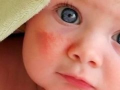 Сыпь на попе у ребенка — симптом пеленочного дерматита
