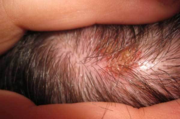 Болячка на голове под волосами: возможные причины появления и методы лечения