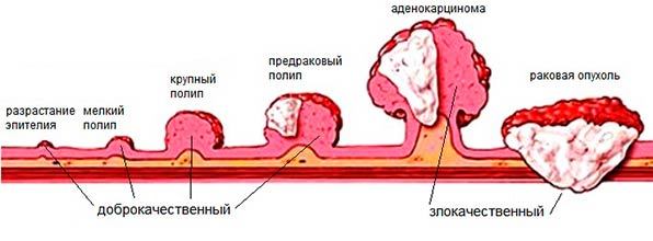 Полипы в поджелудочной железе: причины и лечение