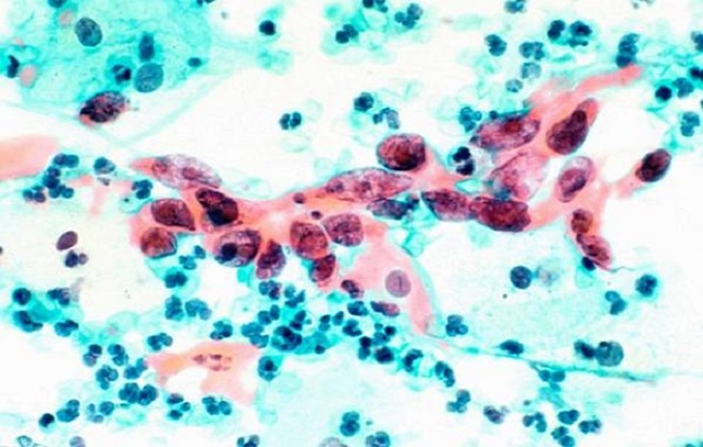 Лейкопения: лейкоциты при онкологии - сколько должно быть, уровень лейкоцитов при раке, показатели