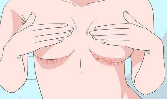 Грибок под грудными железами у женщин: рецепты и мази для лечения