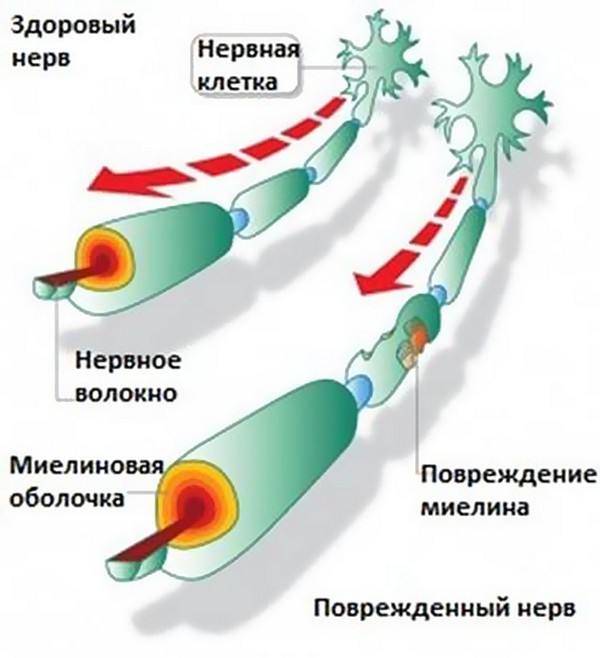 Рассеянный склероз и беременность, можно ли рожать, отзывы