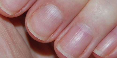 Волнистые ногти на руках: причины почему это возникает