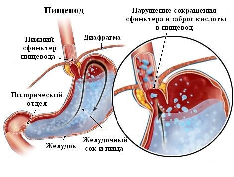 Режущая боль в желудке: что делать при резях, причины и лечение заболеваний