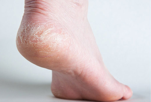 На ступнях ног слезает кожа – фото, причины у взрослых, детей