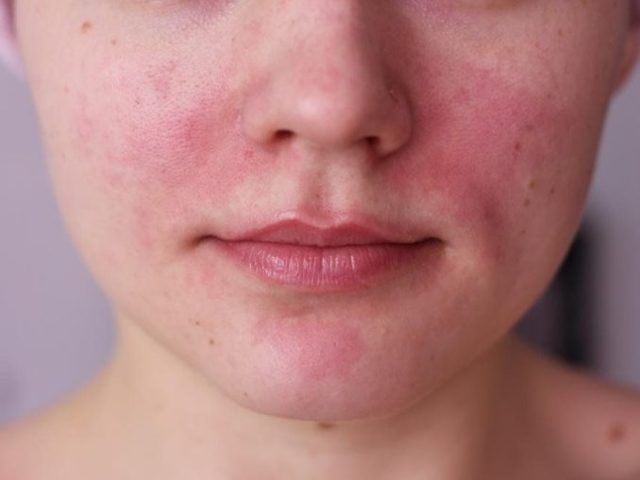 Красные пятна на лице у женщин и мужчин: причины «горящих щек» и методы лечения