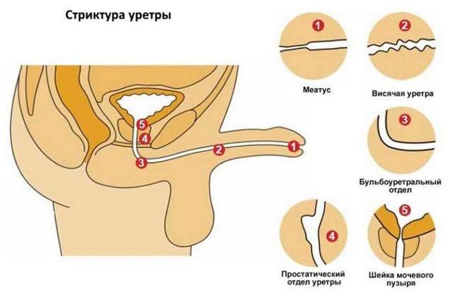 Затрудненное мочеиспускание у мужчин - причины и лечение