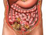 Гнойный перитонит – виды, причины, симптомы и лечение