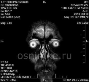 Что показывает МРТ головного мозга