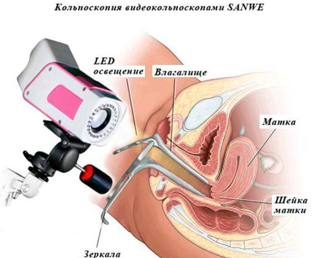 Больно ли делать кольпоскопию или нет: отзывы, техника проведения