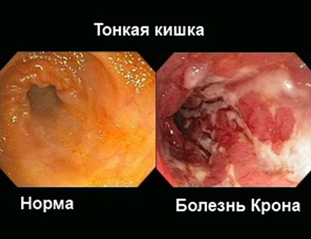 Тонкий кишечник человека, основные заболевания и симптомы