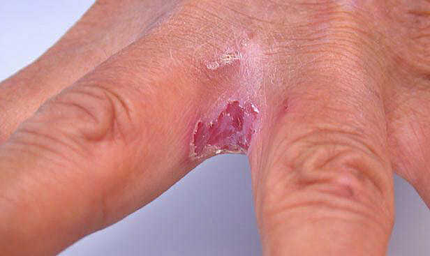 Чешется между пальцами рук: причины покраснения, шелушения и лечение раздражения в домашних условиях