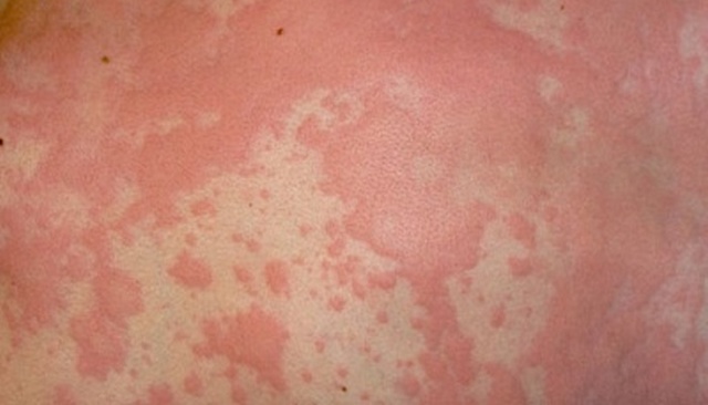 Солнечный дерматит - причины, симптомы, диагностика и лечение