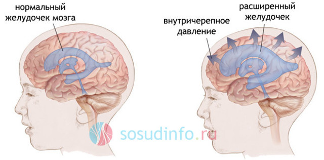 Внутренняя гипертензия головного мозга