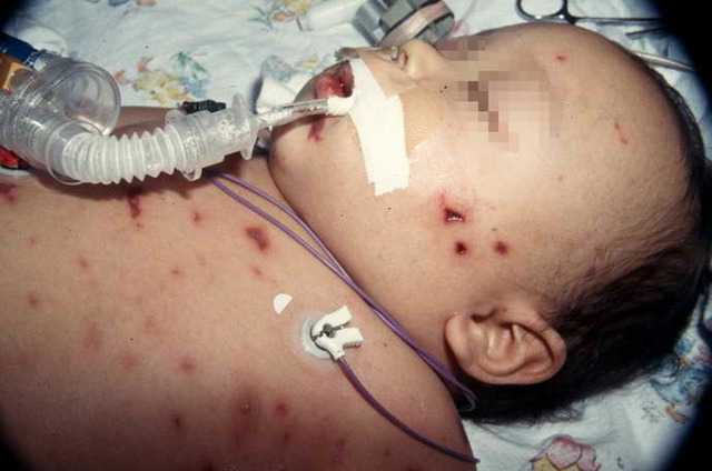 Признаки менингита у детей, сыпь при менингите (фото), как распознать менингит - симптомы у детей